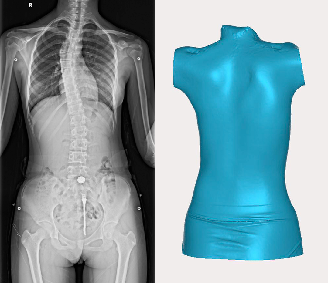 GREENSCANR系列3D掃描儀在脊柱矯正治療中的應用